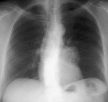 Posteroanterior chest radiograph shows that a smal