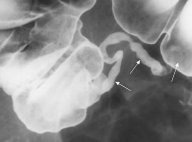 Normal appendix; barium enema radiographic examina