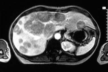 Characteristic appearance of carcinoid liver metas
