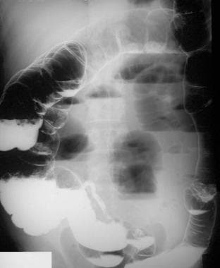 An erect abdominal image obtained as part of a dou