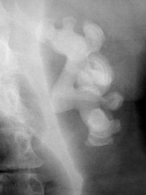 Abdominal radiograph shows calcification filling t