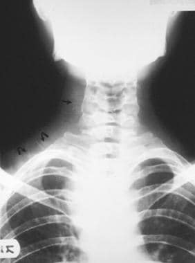 Plain anteroposterior radiograph of the neck shows