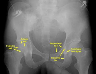 Anteroposterior (AP) radiograph of the pelvis. The