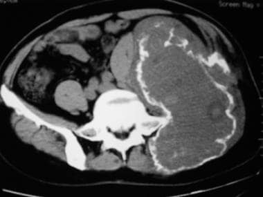 CT scan shows the full extent of a giant cell tumo
