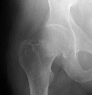 Radiograph demonstrating a Garden I hip fracture. 