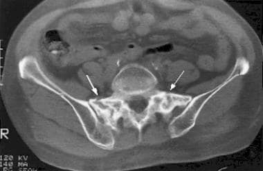 Axial CT of the sacrum reveals fractures (arrows) 