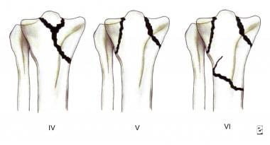 Tibial plateau fractures. Line drawings of Schatzk