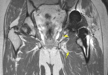 Coronal post contrast T1-weighted MRI depicts a pr