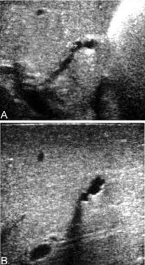 Gallbladder ghost triad in babies with biliary atr