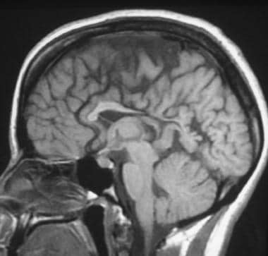 Corpus callosum, agenesis. Sagittal T1-weighted MR