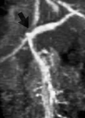 Contrast-enhanced 3-dimensional MR angiogram (grad