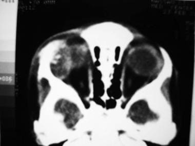 Axial CT scan of the orbits in the same patient as