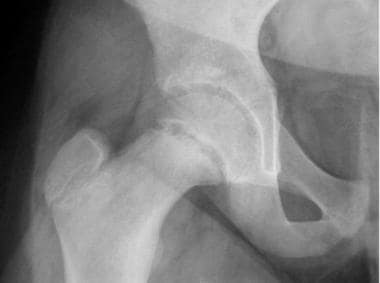 Slipped capital femoral epiphysis. A 13-year-old f