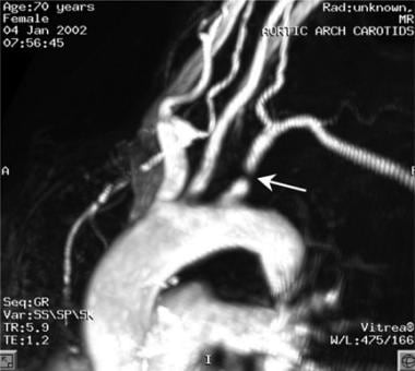 Oblique magnetic resonance angiogram of the aortic