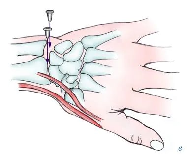 Arthrocentesis of wrist: medial and lateral approa