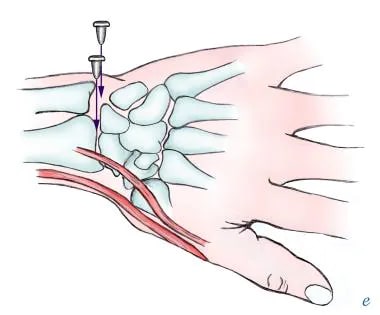 Wrist Arthrocentesis Technique: Aspiration of Wrist Joint, Complications