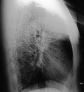 Stage II sarcoidosis. Courtesy of Anthony Notino, 