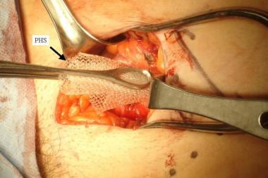 Open inguinal hernia repair. Deployment of Prolene