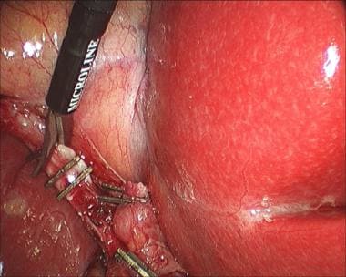Laparoscopic cholecystectomy. Transection of cysti