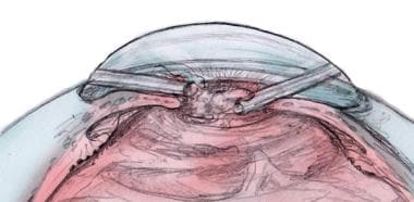 Anterior vitrectomy for ruptured posterior capsule