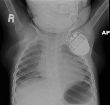 This radiograph depicts a transvenous ventricular