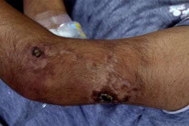 Necrotic lesions of polyarteritis nodosa (PAN). 