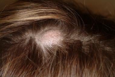 A firm, smooth swelling on the scalp. 