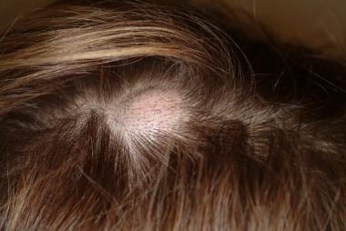 infected sebaceous cyst in scalp