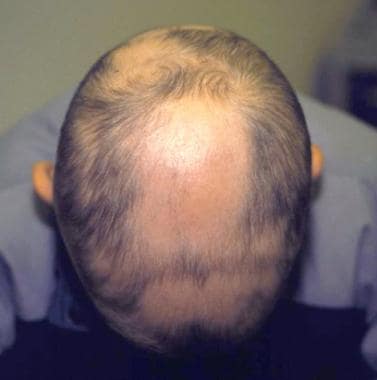 Patchy alopecia areata. 