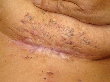 Hidradenitis suppurativa manifesting as hyperpigmented scars and