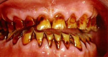 smoke discolouration on teeth