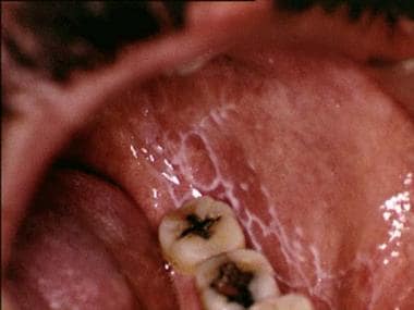Reticular oral lichen planus on the buccal mucosa 