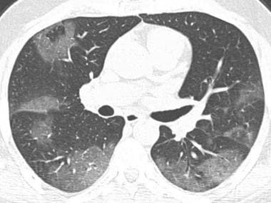 Axial chest CT demonstrates patchy ground-glass op