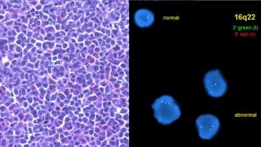 Myeloid Sarcoma Pathology. In the same example of 