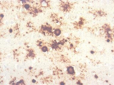Immunocytochemistry for prion protein (PrP) shows 