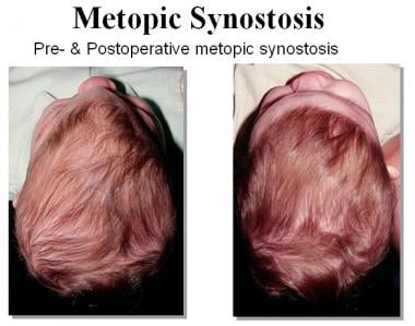 Pre- and postoperative photos of metopic synostosi