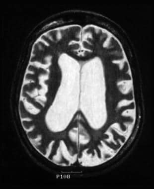 Axial T2-weighted MRI of the brain of a 47-year-ol
