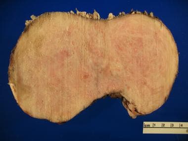 Fibrous Dysplasia Pathology. This gross specimen d