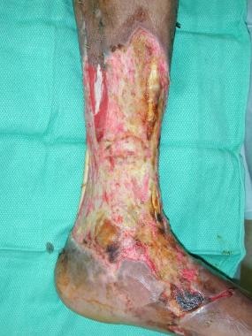 Left lower extremity wound immediately following e
