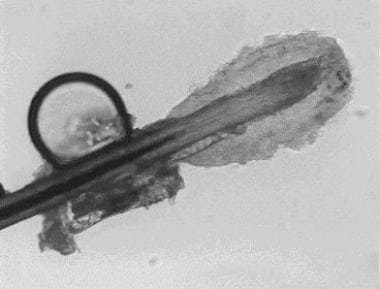 Demodex along the shaft of the cilia. 