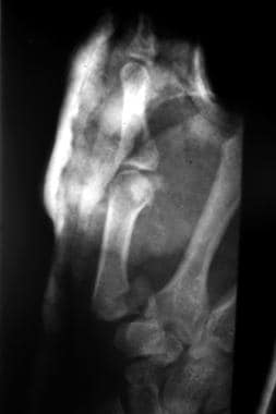 Lateral radiograph of a Rolando fracture. Note how
