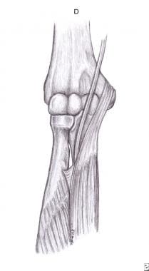 指浅屈肌纤维弓。