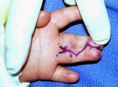 Volar view of hand of 1-year-old patient with comp