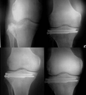 Type III tibial plateau fracture with central depr