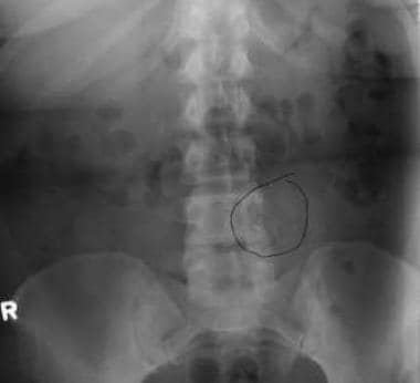 Standard radiograph of an osteoblastoma with a sec