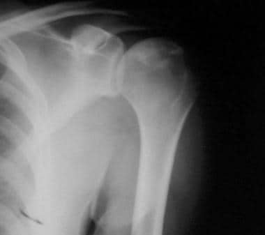 Shoulder osteonecrosis stage II disease. 