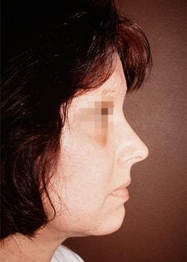Fascial grafts. A 55-year-old woman sought improve