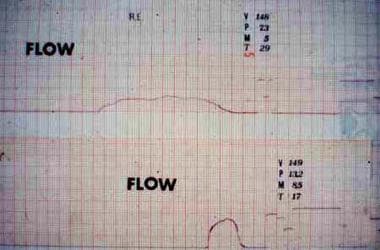 Poor flow rate in a junctional stenosis (above). N