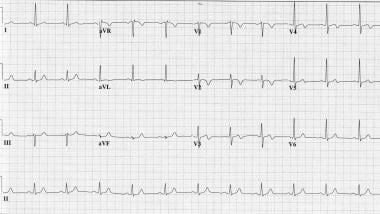 unstable angina ecg