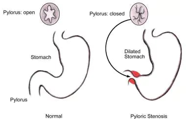 Anatomic changes associated with pyloric stenosis.